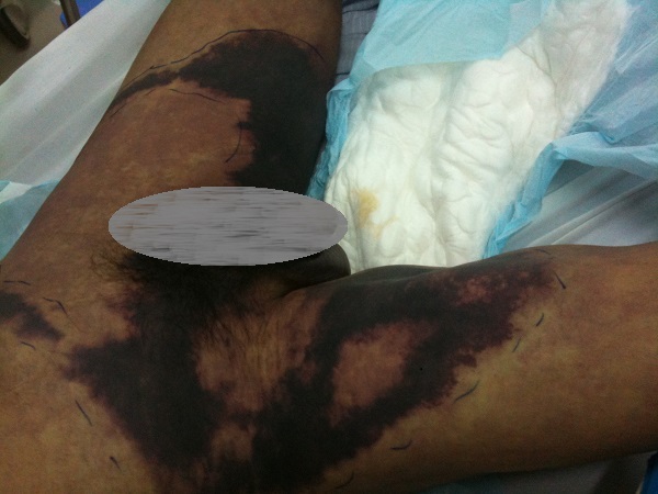 Hoại tử Fournier - Hình ảnh minh họa